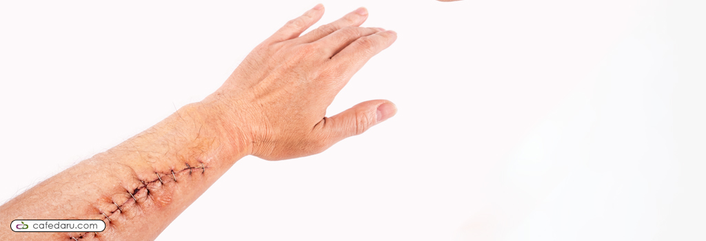 بهبود جای زخم و عوامل مؤثر در آن